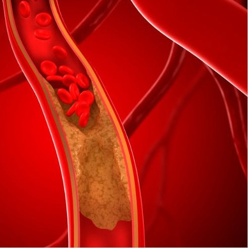 Blocked-Blood-Vessels